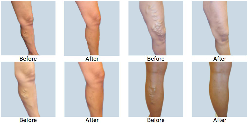 Before and after varicose vein treatment photos